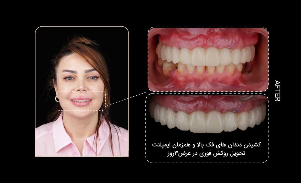 درد بعد از یک هفته و علائم نیازمند بررسی ایمپلنت